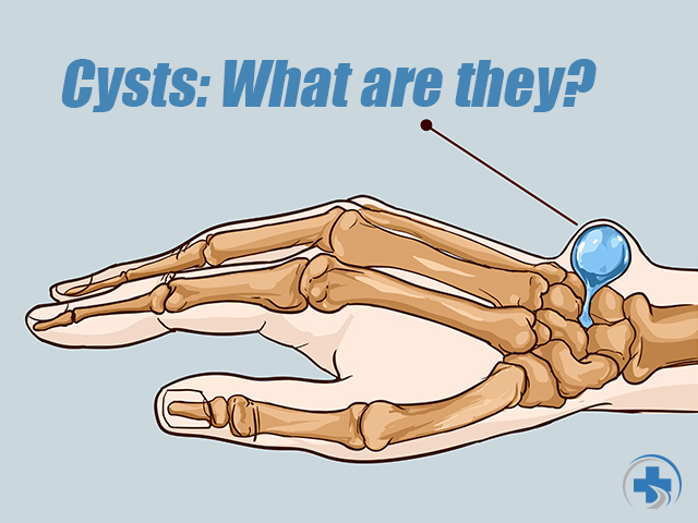 cysts